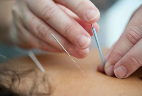 ¿Puede beneficiar la acupuntura a tu esclerosis múltiple?